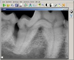 Digitales Dentalröntgen
